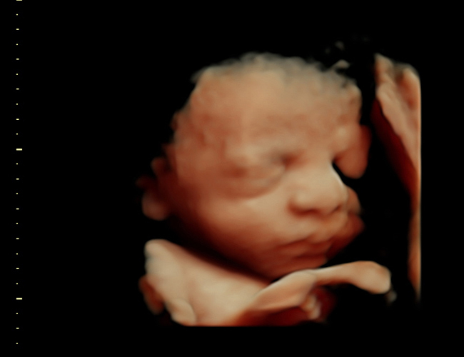 3D ultrasound image at 31 weeks